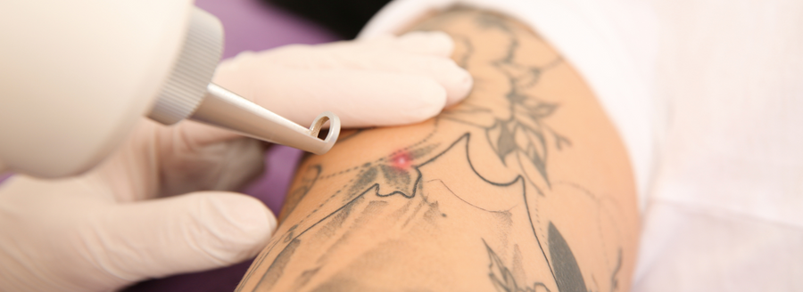 Laser tattoo removal at INK'D London